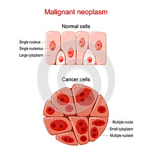 Malignant neoplasm. Cancer and Normal cells photo
