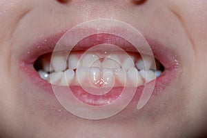 Malocclusion of a child, close-up on the front teeth of a child photo
