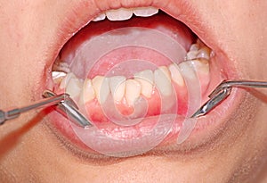 Malocclusion. Crowding of the teeth photo