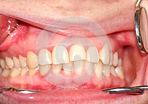 Malocclusion. Curvature of the upper dentition