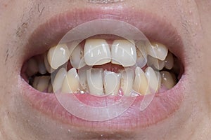 Malocclusion, Overcrowding of both upper and lower teeth