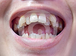 Malocclusion, Overcrowding of both upper and lower teeth