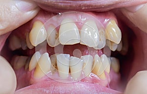 Malocclusion, Overcrowding of both upper and lower teeth
