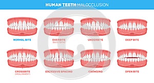 Malocclusion Of Teeth Infographics photo