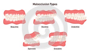 Malocclusion types set. Human crooked teeth. Misalignment or incorrect