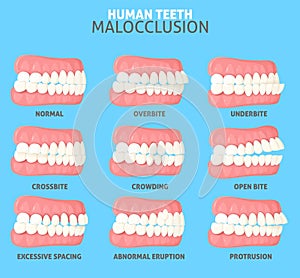 Malocclusion types side view dentist medical poster