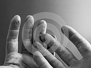 Maltreated hands