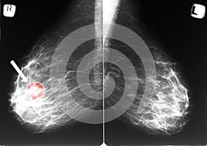 Mammogram with breast cancer