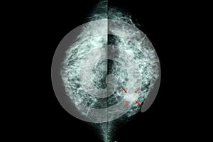 mammogram of female breasts