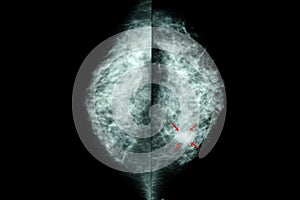 mammogram of female breasts photo