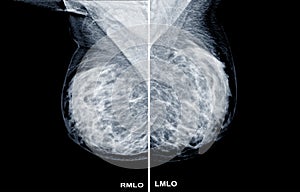 Mammogram radio imaging for breast cancer diagnosis