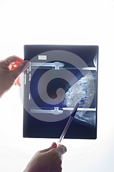 Mammogram x-ray of right breast of a female patient with cysts