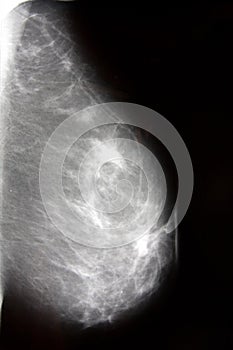Mammography photo