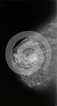 Mammography