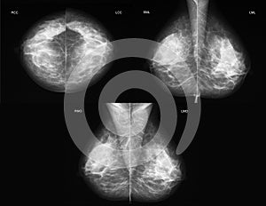Mammography in all projections