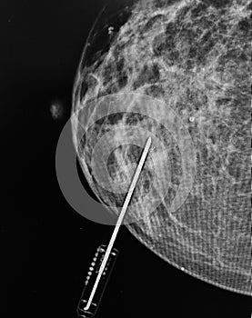 Mammography biopsy needle pathological zone