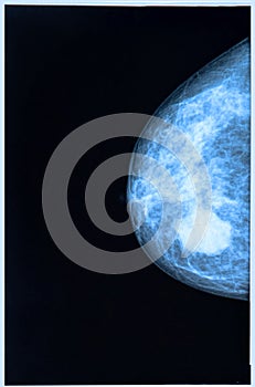 Mammography