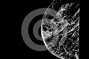 Mammography of a female patient with multiple cysts