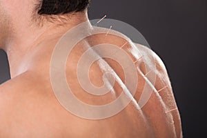 Man with acupuncture needles on back