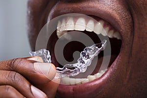 Man Adjusting Transparent Aligners In His Teeth