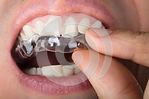 Man Adjusting Transparent Aligners In Teeth