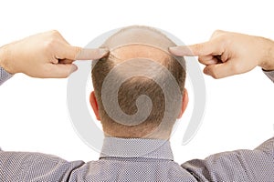 Man alopecia baldness hair loss