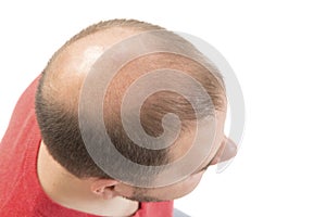 Man alopecia baldness hair loss isolated