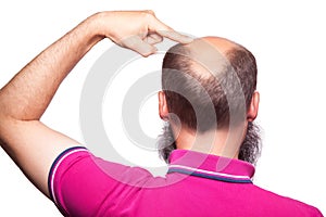 Man alopecia baldness hair loss isolated.