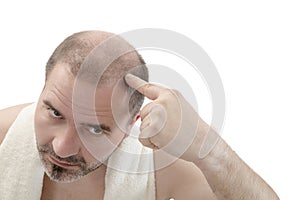 Man alopecia baldness hair loss isolated