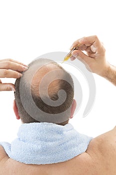 Man alopecia baldness hair loss isolated