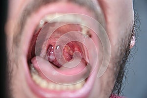 Man with aphthae or sore on his throat. photo