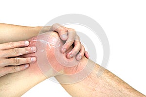 Man apply lotion on sunburnt knee skin, on white background