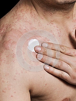 Man Applying Cream On Irritated Skin