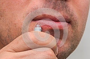 Man applying ointment to herpes on lips for treatment