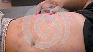 The man applying psoriasis relief cream, Medical and health care concept, The man with skin rash