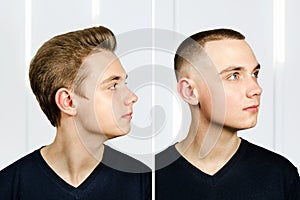 Man before arter haircut with hair loss: bald and pompadour, transplant and transformation in profile fade side