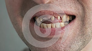 Man with bad diseased teeth affected by caries and periodontitis, smoker yellow teeth . Male touch his teeth prepared