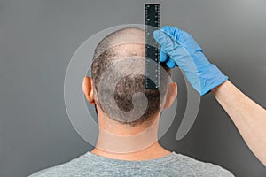 A man with baldness on his head is examined by a trichologist. The doctor& x27;s hand measures the bald spot with a ruler