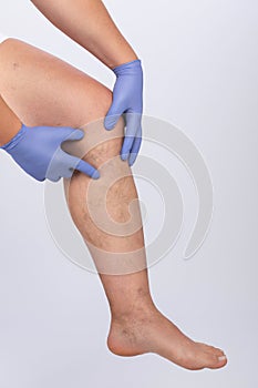 Man in blue gloves shows  the dilation of small blood vessels of the skin on the leg. Medical inspection and treatment of