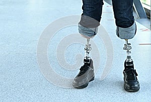 a man with bone-implanted leg prostheses. osteointegration photo