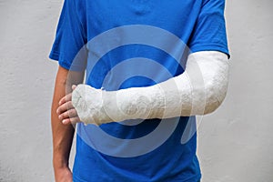 Man with broken arm wrapped medical cast plaster. Fiberglass cast covering the wrist, arm, elbow after sport accident, isolated on