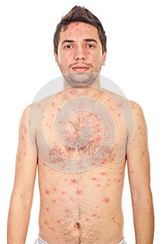 Man with chickenpox