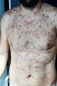 Man with chickenpox