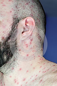 Man with chickenpox