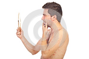 Man with chickenpox looking in mirror