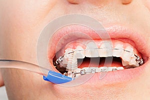 Man cleaning his teeth brace by brush photo