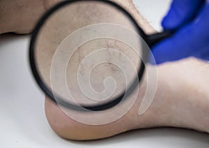 Man in consultation with a vascular surgeon. A doctor examines a leg with swollen veins. Varicose veins on the leg