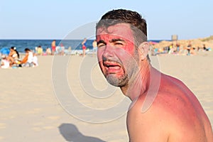 Man crying after getting wildly sunburned