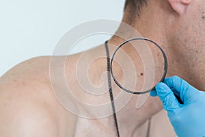 A man at a dermatologist appointment shows his birthmarks, moles and nevi. The doctor examines the patient with a