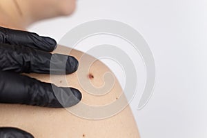 A man at a dermatologist appointment shows his birthmarks, moles and nevi. The doctor examines the patient with a dermatoscope.